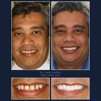 Bridgeview Dental - Smile Makeover Before & After

Dr. Lance Loveless, DDS, FAGD, LVIF
Dentist in Austin, TX
Bridgeview Dental
3801 N Capital of ... - General Dentistry Near Me - Austin, Texas
