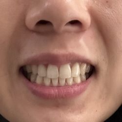Torrey Hills Orthodontics - After