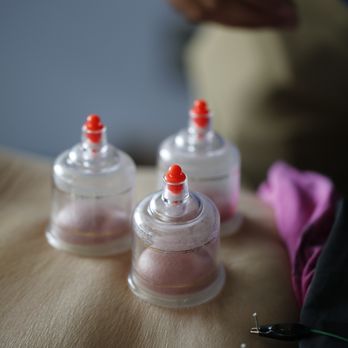 NewCare Physical Therapy - Cupping - Physical Therapy Near Me - Norcross, Georgia NewCare Physical Therapy - Cupping - Physical Therapy Near Me - Norcross, Georgia