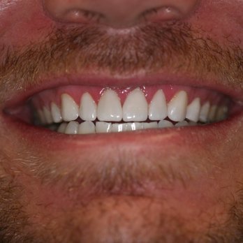 Precious Smiles - After 10 Veneers-Dentistry by Dr. Kaocharoen. - General Dentistry Near Me - Scottsdale, Arizona Precious Smiles - After 10 Veneers-Dentistry by Dr. Kaocharoen. - General Dentistry Near Me - Scottsdale, Arizona