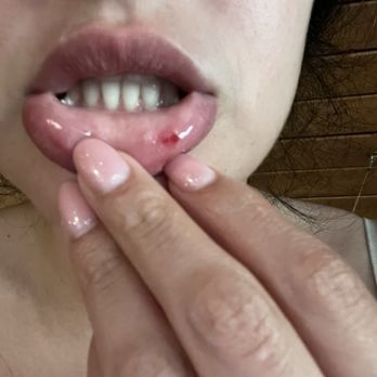 Ocean - My lip after I bit into the lobster shell inside my roll and all they did was "apologize" and joke I was getting "real lobster" - Seafood Near Me - Bayville, New York Ocean - My lip after I bit into the lobster shell inside my roll and all they did was "apologize" and joke I was getting "real lobster" - Seafood Near Me - Bayville, New York