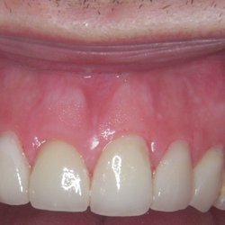 Edward Rosenthal, DDS - Porcelain Veneers