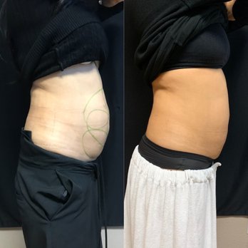 Freeze M.D. Coolsculpting Center - Left side is before Right is after - Body Contouring Near Me - Chino, California Freeze M.D. Coolsculpting Center - Left side is before Right is after - Body Contouring Near Me - Chino, California
