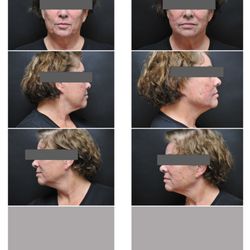 Dhillon Satwant, MD - SILHOUETTE INSTALIFT Before and After