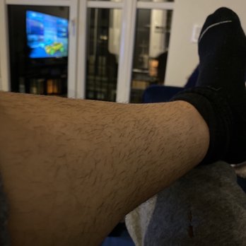 West U Laser - Where we started!!! I can't even believe this was my leg!!! - Laser Hair Removal Near Me - Houston, Texas West U Laser - Where we started!!! I can't even believe this was my leg!!! - Laser Hair Removal Near Me - Houston, Texas