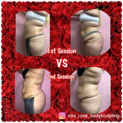 Mía Rose Body Sculpting - Ultrasound Cavitation + Mía Rose Booty Pop (Buttlift)