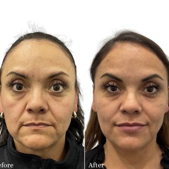 BeauTech Cosmetic Center - Filler and Botox before and after - Medical Spas Near Me - Studio City, California