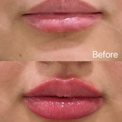 One Beauty Aesthetics - Juvéderm Ultra XC