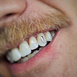 Groovy Glow Teeth Whitening
