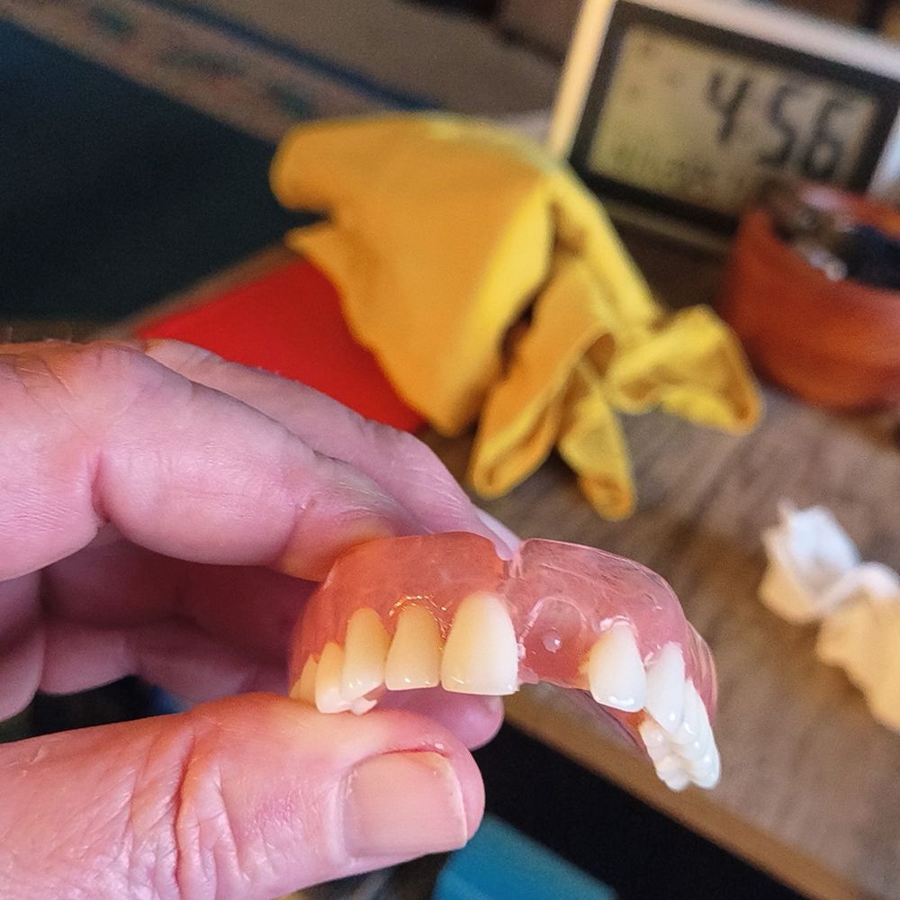 Washington Dental Clinic - Faulty Dentures #2 - General Dentistry Near Me - Tijuana, BCN