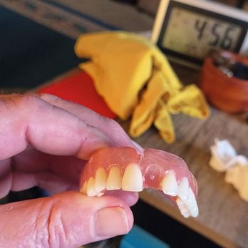 Washington Dental Clinic - Faulty Dentures #2 - General Dentistry Near Me - Tijuana, BCN Washington Dental Clinic - Faulty Dentures #2 - General Dentistry Near Me - Tijuana, BCN