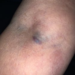 Patient Service Center - Bulge & bruise from a routine blood test.