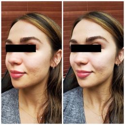 Cheek filler before and after.