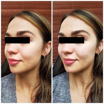 Raise The Bar Med Spa - Cheek filler before and after. - Medical Spas Near Me - Gilbert, Arizona