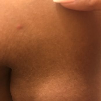 Spring Spa - Bed bug bites/ insect bites from sheets/ location. - Day Spas Near Me - Las Vegas, Nevada Spring Spa - Bed bug bites/ insect bites from sheets/ location. - Day Spas Near Me - Las Vegas, Nevada