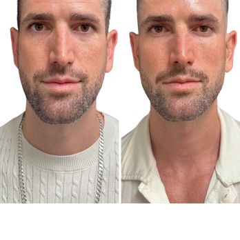 SkinSpirit - Long Beach - Before + After - Skin Care Near Me - Long Beach, California