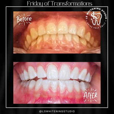 Teeth Whitening-Before and after - Say goodbye to yellow and stain teeth with our safe and professional teeth whitening in just one hour.  Our professional teeth whitening brings natural results with little to NONE sensitivity. 
Hablamos Español!
BOOK YOUR APPOINTMENT AND EXPERIENCE THE CONFIDENCE OF A WHITER SMILE!