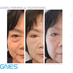 The Total You Medical Spa - Non-Sugary eyebag removal