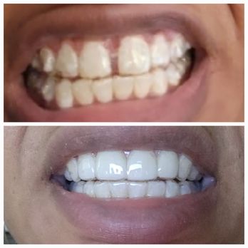 Smile HQ - Before and After Invisalign Treatment at SmileHQ - Orthodontists Near Me - Washington, DC, District of Columbia Smile HQ - Before and After Invisalign Treatment at SmileHQ - Orthodontists Near Me - Washington, DC, District of Columbia