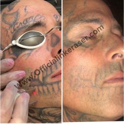 The INK Eraser - After 3 sessions on homemade tattoo ink 
No skin damage
