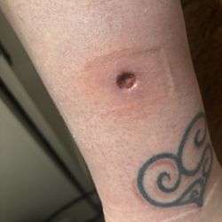 McCray Dermatology - Basal cell carcinoma removal leg.