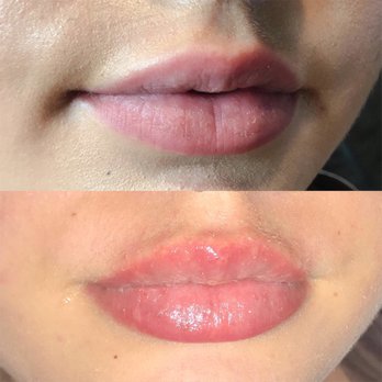 ElyssaAesthetics - Before + after needle less lip filler - Eyelash Service Near Me