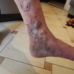 The Center For Advanced Vein Treatment - Varicose Vein Treatment
