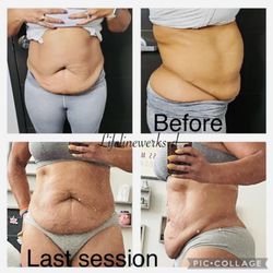 Life Line Werks - Service performed: Laser lipo, Cavitation, Skin Tightening, and Vacuum Therapy for 30 days.