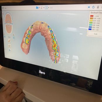Mia Smiles Orthodontics - Scan showing my occlusion - Orthodontists Near Me - Miami, Florida Mia Smiles Orthodontics - Scan showing my occlusion - Orthodontists Near Me - Miami, Florida