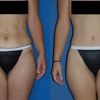 Brucker Plastic Surgery - Body Lift - Cosmetic Surgeons Near Me - La Jolla, California Brucker Plastic Surgery - Body Lift - Cosmetic Surgeons Near Me - La Jolla, California