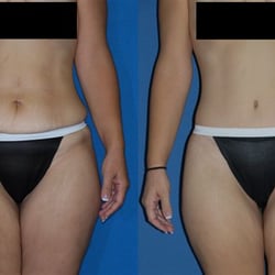 Brucker Plastic Surgery - Body Lift