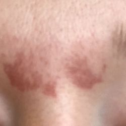 Julian's Hair Design - Burns from wax