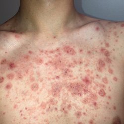 Skin and Cancer Associates - Day 1 acne before starting Acutane