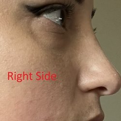 Mountain Home ENT and Allergy - This is 10 months after surgery.