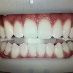 N & M Dental Care - Whitening case: after treatment.