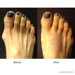 Evo Advanced Foot Surgery - Before and After of a bunion surgery by Dr. Ali Sadrieh