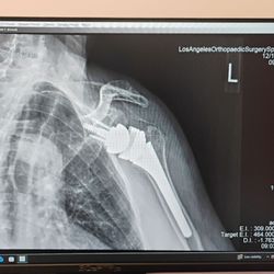 Los Angeles Orthopaedic Surgery Specialists - X-ray after shoulder replacement surgery showing pin and ball implants.