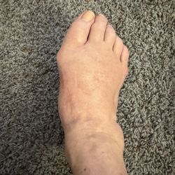 Orthopedic Associates - My foot that Dr Moran did surgery on. Deformed and can't wear regular shoes !!!