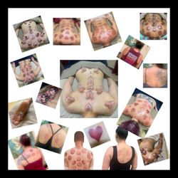 Mind Body & Massage Spa - Cupping Therapy