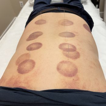 Bayhill Acupuncture - Acupuncture Near Me - San Bruno, California