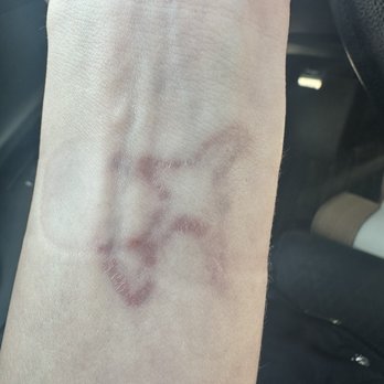 MEDermis Tattoo Removal - Tattoo Removal Near Me - San Antonio, Texas MEDermis Tattoo Removal - Tattoo Removal Near Me - San Antonio, Texas