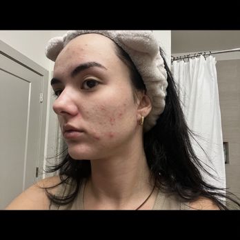 Az Skin Rehab - When I started - Day Spas Near Me - Chandler, Arizona