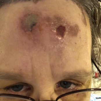 Novus Clinic - Surgical site blisters. - Ophthalmologists Near Me - Tallmadge, Ohio Novus Clinic - Surgical site blisters. - Ophthalmologists Near Me - Tallmadge, Ohio