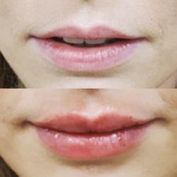 NurturHer Aesthetics - Lip enhancement with Versa lip filler