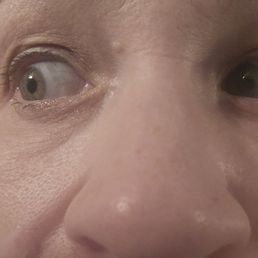 Sunken eyes from lower blepharoplasty Sunken eyes from lower blepharoplasty