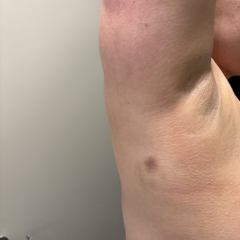 King Spa & Sauna - Bruises from full body scrub - Day Spas Near Me - Niles, Illinois King Spa & Sauna - Bruises from full body scrub - Day Spas Near Me - Niles, Illinois