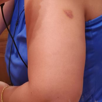 Molly Darcy's Irish Pub and Restaurant - Bruising from worker putting me in a hold - Irish Near Me - Danbury, Connecticut Molly Darcy's Irish Pub and Restaurant - Bruising from worker putting me in a hold - Irish Near Me - Danbury, Connecticut