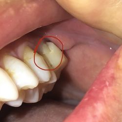 Dental Center of Midlothian - A broken temporary. It did not cover the tooth.