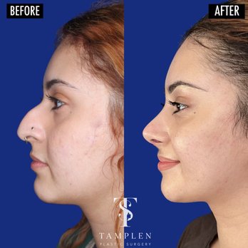 Tamplen Plastic Surgery - Loving her new nose just 1 month after Rhinoplasty! - Plastic Surgeons Near Me - Orinda, California Tamplen Plastic Surgery - Loving her new nose just 1 month after Rhinoplasty! - Plastic Surgeons Near Me - Orinda, California