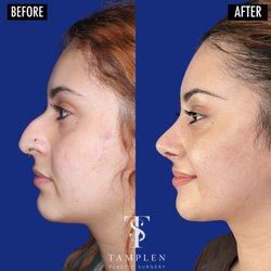 Tamplen Plastic Surgery  - Loving her new nose just 1 month after Rhinoplasty!